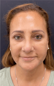 Facelift-Case--6496 | After Facelift 1