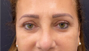 Quad-Blepharoplasty-Case--2302 | After Eyelid Surgery 1