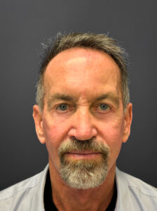 After Facelift, Rhinoplasty, Blepharoplasty (Front)