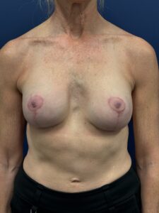 Augmentation-Mastopexy-Case--1505 | After Breast Augmentation With Lift 1