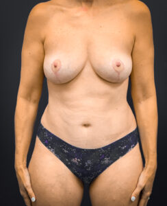 Breast-Augmentation-Case--1469 | After Breast Augmentation 1