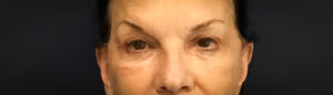Upper-Blepharoplasty-Case--2075 | After Eyelid Surgery 1