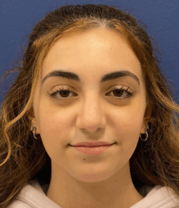 Rhinoplasty-Case--2537 | After Rhinoplasty 1