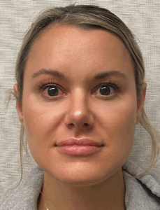 Rhinoplasty-Case--4972 | After Rhinoplasty 1