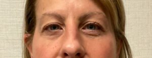 Upper-Blepharoplasty-Case--7202 | After Eyelid Surgery 1