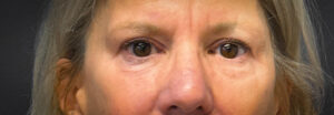 Blepharoplasty-Case--2653 | After Eyelid Surgery 1