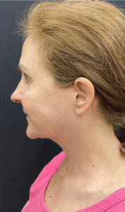 Necklift-Case--4836 | After Neck Lift 2