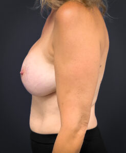 Breast-Augmentation-Case--3336 | After Breast Augmentation 2