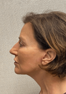 Case--6591 | After Facelift 2