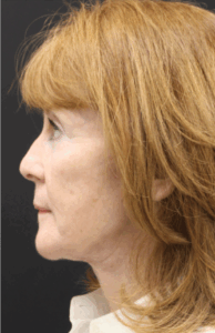Face-and-Neck-Lift-Case--9302 | After Neck Lift 2