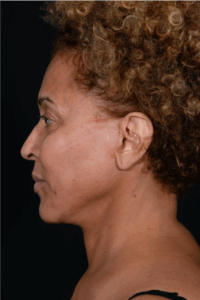 Face-and-Neck-Lift-Case--3772 | After Neck Lift 2