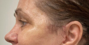 Quad-Blepharoplasty-Case--1851 | After Eyelid Surgery 2