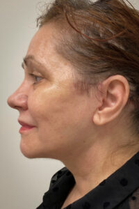 Facelift-Case--6254 | After Facelift 2