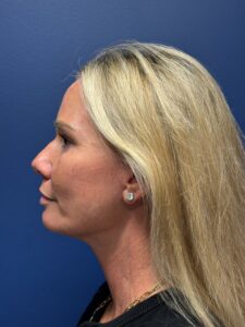 Quad-Blepharoplasty-Case--4265 | After Eyelid Surgery 2