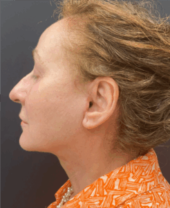 Face-and-Neck-Lift-Case--8423 | After Neck Lift 2