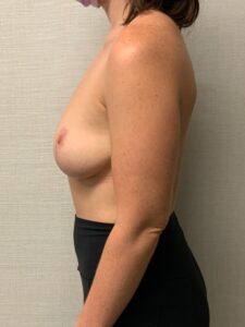 Implant-Removal-Case--6466 | After Dr. Arjun Kanuri 2