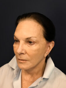 Revision-Facelift-Case--3082 | After Facelift 2