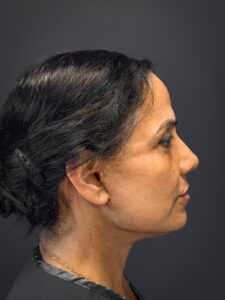 Facelift-Case--7062 | After Facelift 2