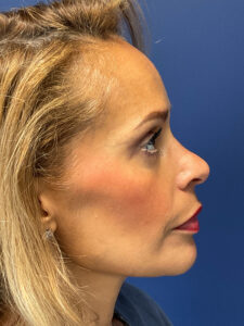 Facial-Fat-Grafting-Case--4152 | After Facial Fat Grafting 2