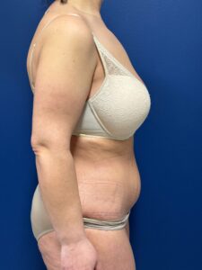 Abdominoplasty-Case--3602 | After Tummy Tuck 2