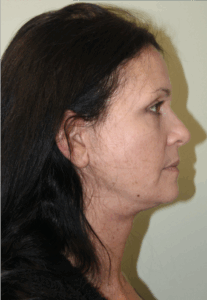Face-and-Neck-Lift-Case--9403 | After Neck Lift 2