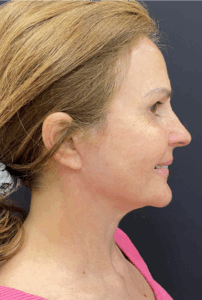 Facelift-Case--4160 | After Facelift 2