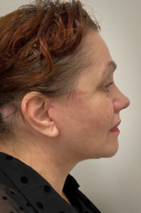 Facelift-Case--6254 | After Facelift 1