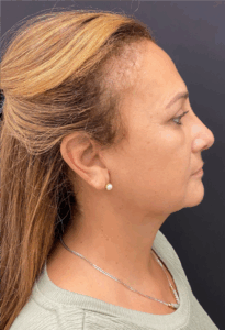 Facelift-Case--6496 | After Facelift 2