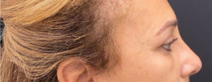 Brow-Lift-Case--6540 | After Brow Lift 2