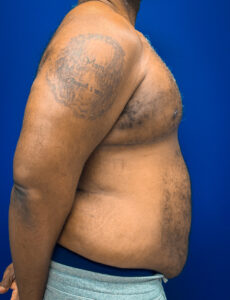 Gynecomastia-Case--4473 | After Gynecomastia / Male Breast Reduction 2