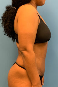 Abdominoplasty-Case--1110 | After Tummy Tuck 2