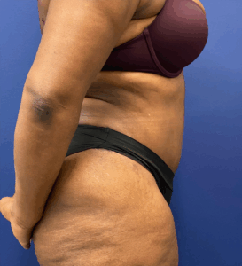 Abdominoplasty-Case--4427 | After Tummy Tuck 2