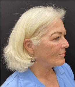 Face-and-Neck-Case--1975 | After Neck Lift 2