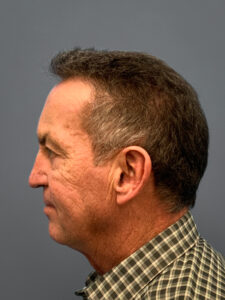 Before Facelift, Rhinoplasty, Blepharoplasty (Side)