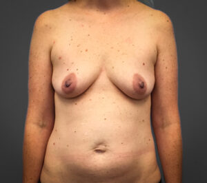 Before Breast Augmentation (Front)