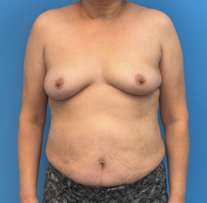 Breast-Reconstruction-Case--28751 | Before Breast Reconstruction 1
