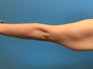 Case--276 | Before Arm Lift 1