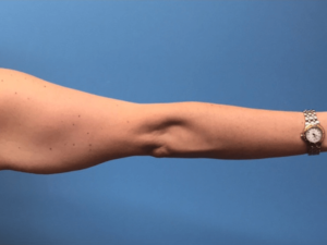 Case--276 | Before Arm Lift 2