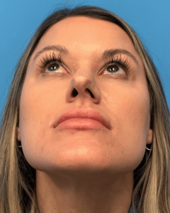 Case--23703 | Before Rhinoplasty 2