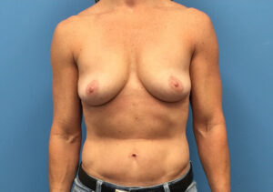 Case--230 | Before Breast Augmentation With Lift 1