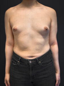 Front profile of patient before undergoing breast augmentation surgery