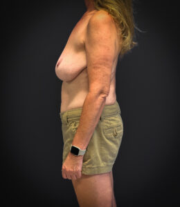 Before Mastopexy and galaflex (left side profile)