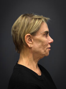 Facelift-Case--4219 | Before Facelift 2