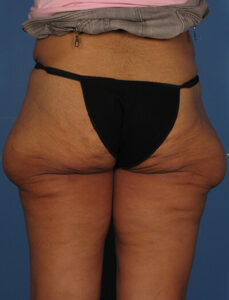 Case--75 | Before Thigh Lift 2