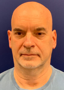 Case--22080 | Before Neck Lift 1