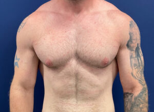 Case--28230 | Before Gynecomastia / Male Breast Reduction 1