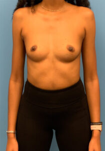 Case--26022 | Before Breast Augmentation 1