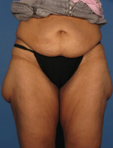 Case--75 | Before Thigh Lift 1