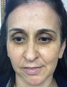 Case--36 | Before CPS Plastic Surgeons 1