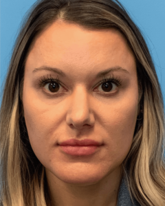 Case--23703 | Before Rhinoplasty 1